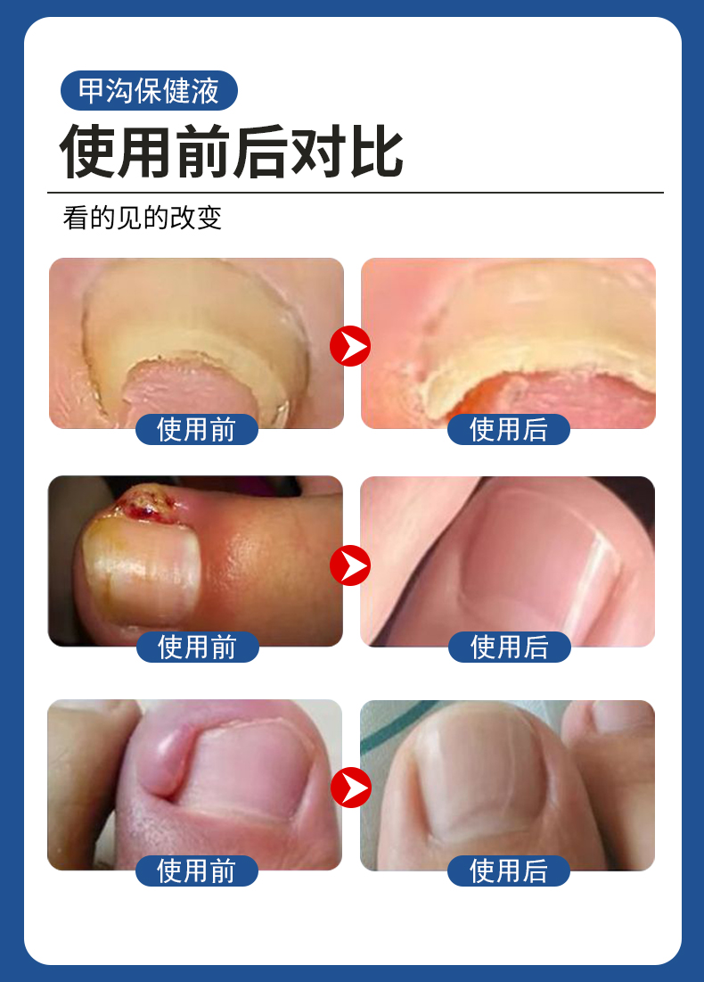 甲溝炎專用液有用嗎？使用前后對比